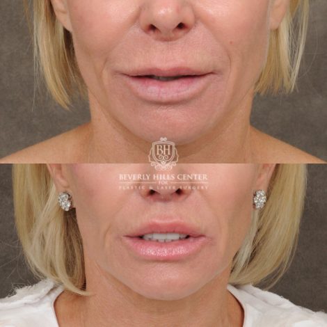 female patient before and after CUPID LIFT® Lip Lift