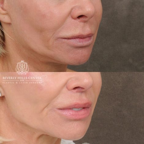 female patient before and after CUPID LIFT® Lip Lift