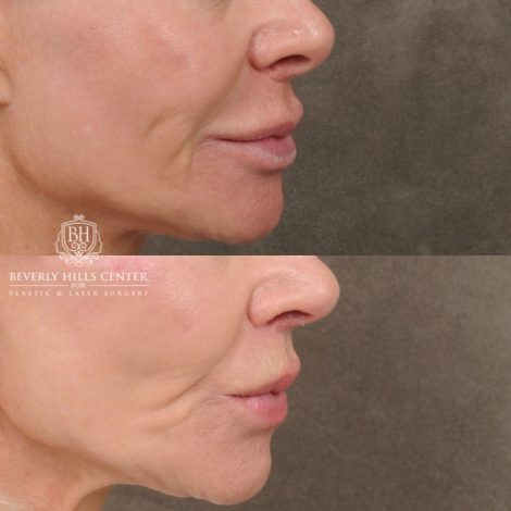 female patient before and after CUPID LIFT® Lip Lift