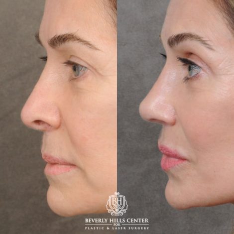 female patient before and after Profound RF, Revision Rhinoplasty, Brow Lift