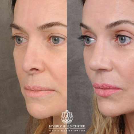 female patient before and after Profound RF, Revision Rhinoplasty, Brow Lift