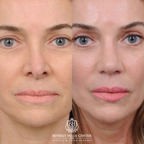 female patient before and after Profound RF, Revision Rhinoplasty, Brow Lift