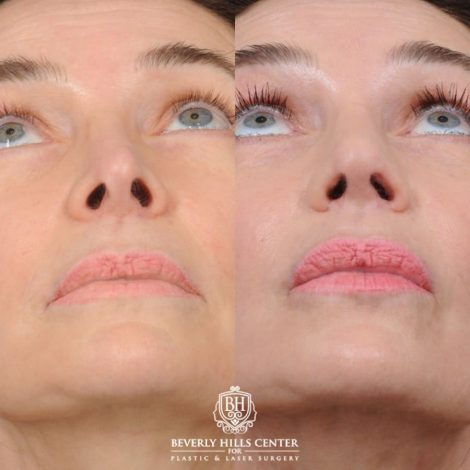 female patient before and after Profound RF, Revision Rhinoplasty, Brow Lift