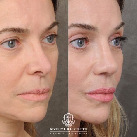 female patient before and after Profound RF, Revision Rhinoplasty, Brow Lift