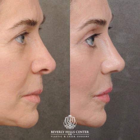 female patient before and after Profound RF, Revision Rhinoplasty, Brow Lift