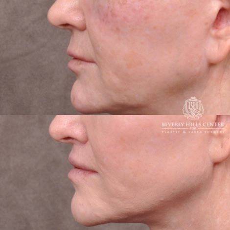 female patient before and after Lip Lift
