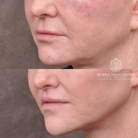 female patient before and after Lip Lift