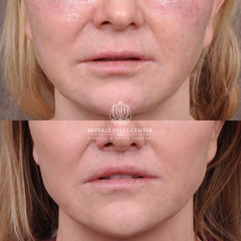 female patient before and after Lip Lift