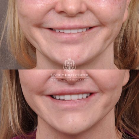 female patient before and after Lip Lift