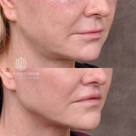 female patient before and after Lip Lift