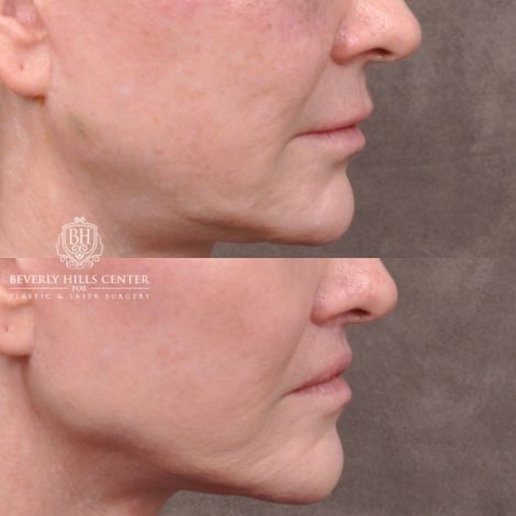 female patient before and after Lip Lift