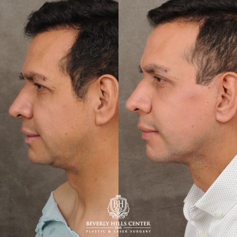 male patient before and after AuraLyft, Brow Lift