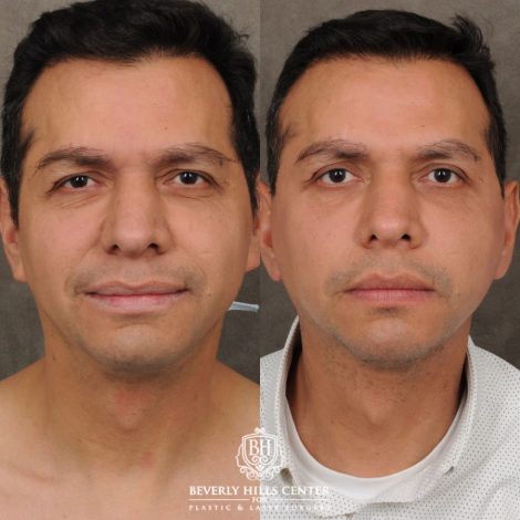 male patient before and after AuraLyft, Brow Lift