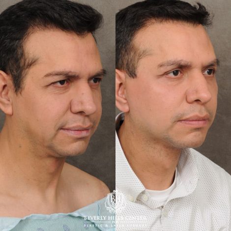 male patient before and after AuraLyft, Brow Lift
