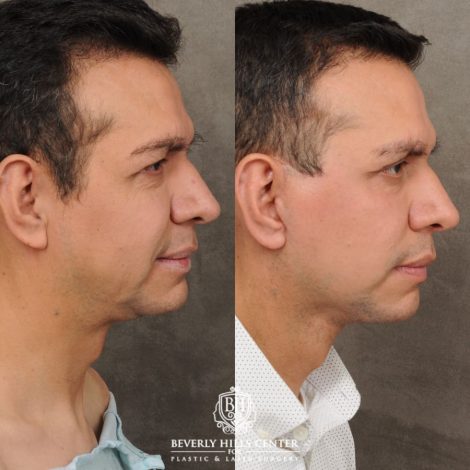 male patient before and after AuraLyft, Brow Lift