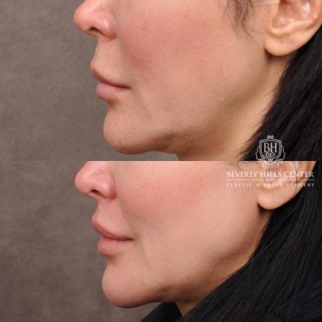 female patient before and after CUPID LIFT® Lip Lift