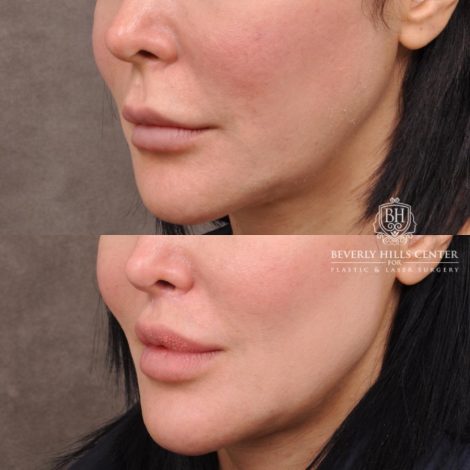 female patient before and after CUPID LIFT® Lip Lift