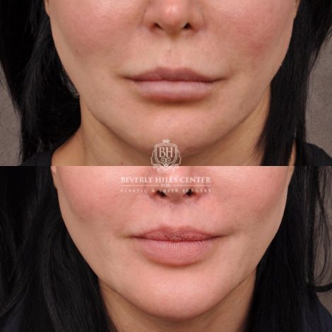female patient before and after CUPID LIFT® Lip Lift