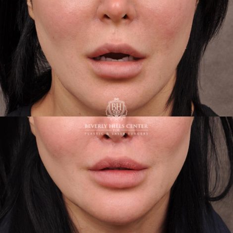 female patient before and after CUPID LIFT® Lip Lift
