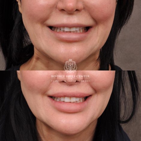 female patient before and after CUPID LIFT® Lip Lift