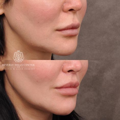 female patient before and after CUPID LIFT® Lip Lift