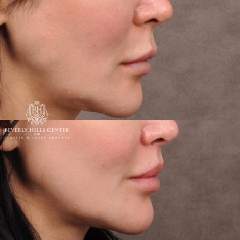 female patient before and after CUPID LIFT® Lip Lift