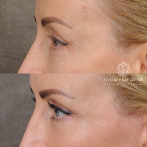 female patient before and after AuraLyft, Forehead Lowering, Ptosis Repair & Fat Grtafting