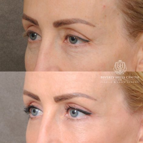 female patient before and after AuraLyft, Forehead Lowering, Ptosis Repair & Fat Grtafting