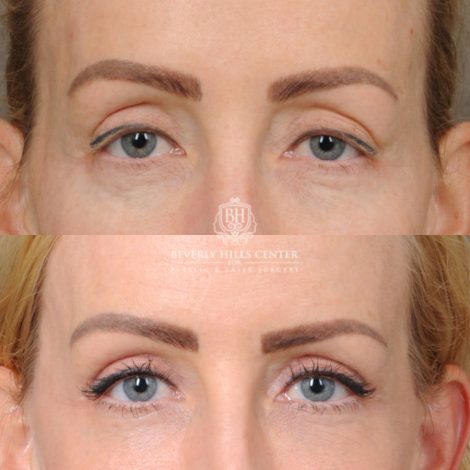 female patient before and after AuraLyft, Forehead Lowering, Ptosis Repair & Fat Grtafting