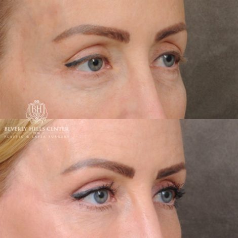 female patient before and after AuraLyft, Forehead Lowering, Ptosis Repair & Fat Grtafting