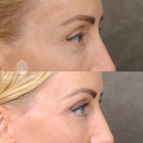 female patient before and after AuraLyft, Forehead Lowering, Ptosis Repair & Fat Grtafting