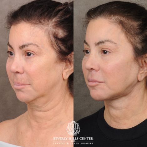 female patient before and after AuraLyft, CUPID LIFT® Lip Lift, Buccal Fat and Nanofat