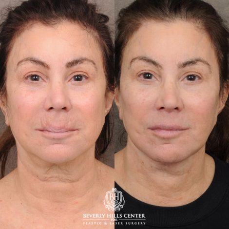 female patient before and after AuraLyft, CUPID LIFT® Lip Lift, Buccal Fat and Nanofat