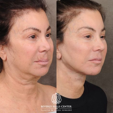 female patient before and after AuraLyft, CUPID LIFT® Lip Lift, Buccal Fat and Nanofat