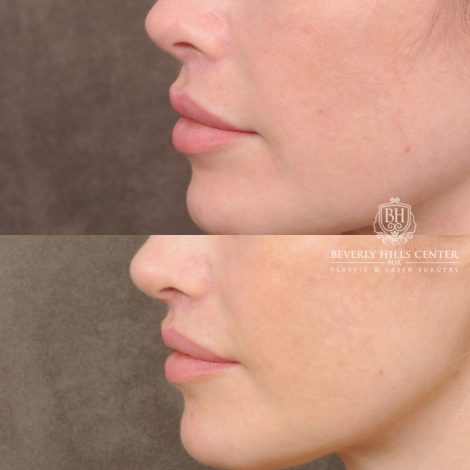 female patient before and after CUPID LIFT® Lip Lift