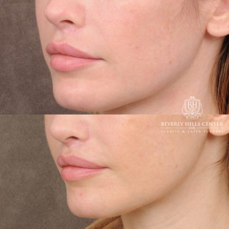 female patient before and after CUPID LIFT® Lip Lift