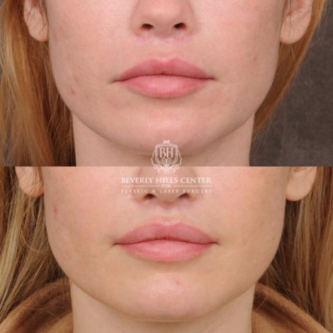 female patient before and after CUPID LIFT® Lip Lift