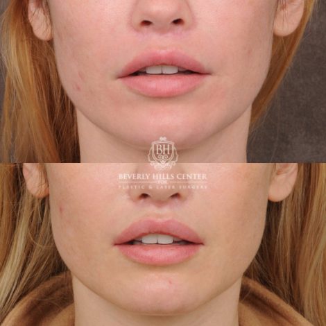 female patient before and after CUPID LIFT® Lip Lift
