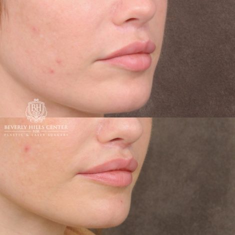 female patient before and after CUPID LIFT® Lip Lift