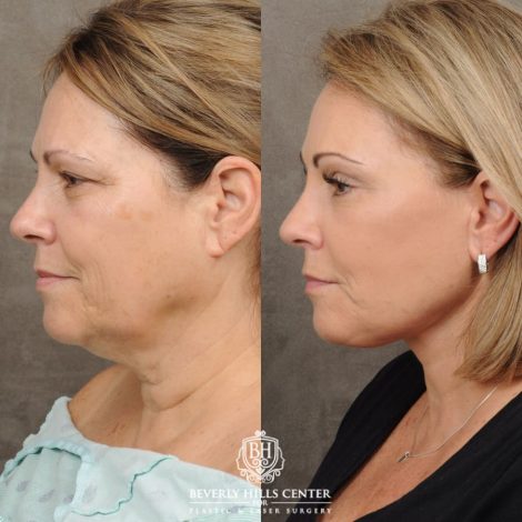 female patient before and after Comprehensive AuraLyft, Brow Lift, Upper & Lower Blepharoplasty, CUPID LIFT®, Buccal Fat Transfer
