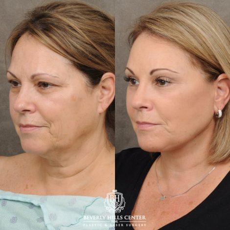 female patient before and after Comprehensive AuraLyft, Brow Lift, Upper & Lower Blepharoplasty, CUPID LIFT®, Buccal Fat Transfer