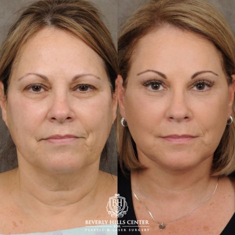female patient before and after Comprehensive AuraLyft, Brow Lift, Upper & Lower Blepharoplasty, CUPID LIFT®, Buccal Fat Transfer