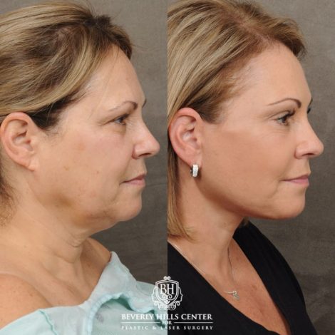 female patient before and after Comprehensive AuraLyft, Brow Lift, Upper & Lower Blepharoplasty, CUPID LIFT®, Buccal Fat Transfer