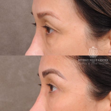 Beverly Hills Center Female Patient Before and After Upper and Lower Blepharoplasty