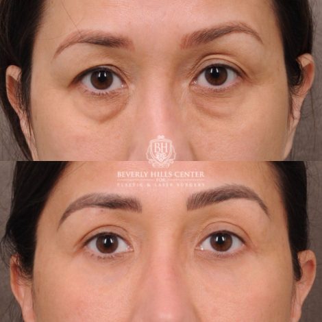 Beverly Hills Center Female Patient Before and After Upper and Lower Blepharoplasty