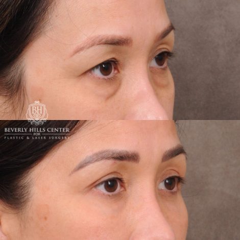Beverly Hills Center Female Patient Before and After Upper and Lower Blepharoplasty