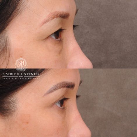 Beverly Hills Center Female Patient Before and After Upper and Lower Blepharoplasty