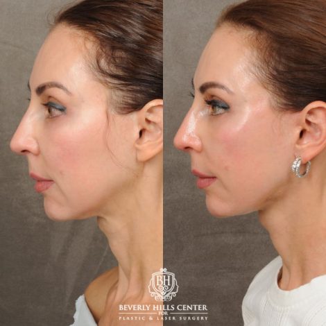 female patient before and after AuraLyft with Upper Bleharoplasty & Ptosis Repair