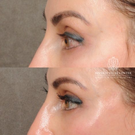 female patient before and after AuraLyft with Upper Bleharoplasty & Ptosis Repair