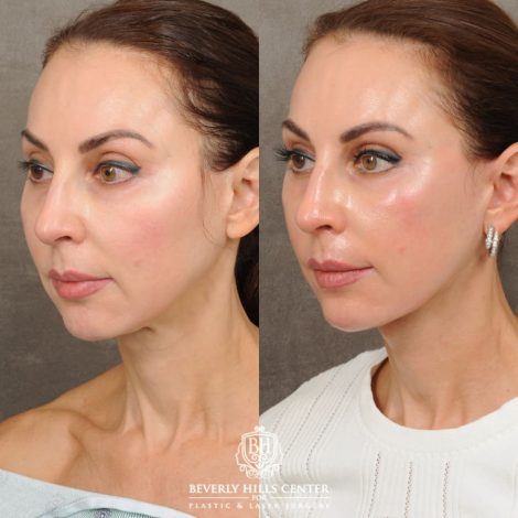 female patient before and after AuraLyft with Upper Bleharoplasty & Ptosis Repair